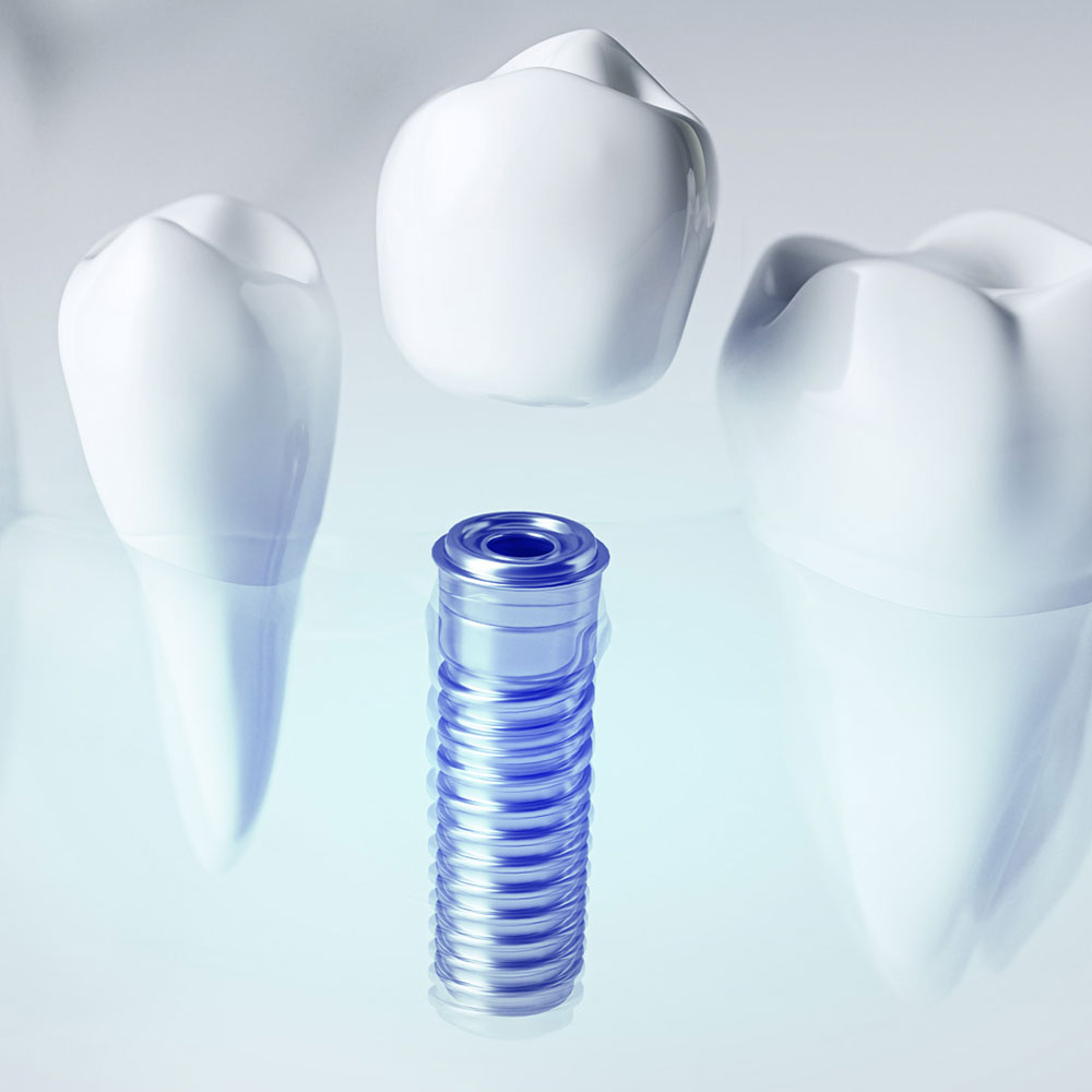 Implantes dentales