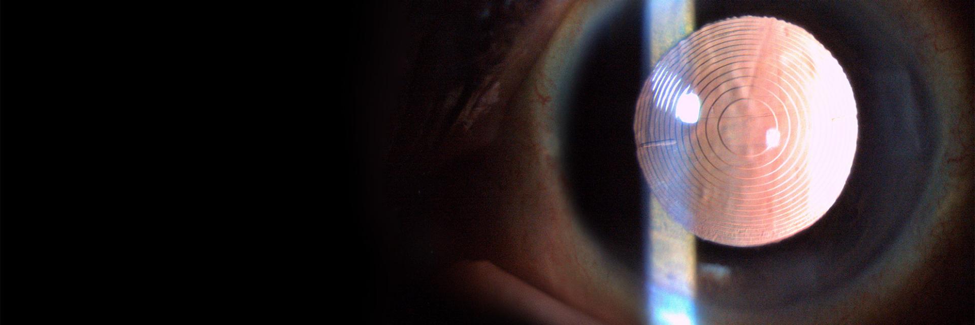 Manejo del astigmatismo