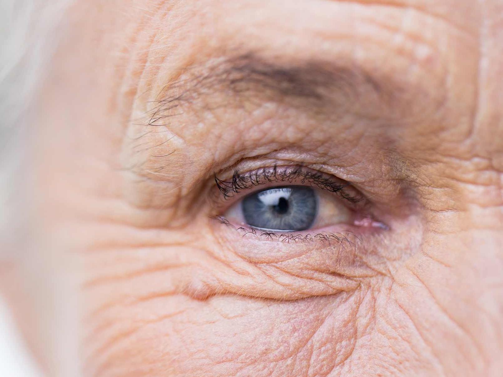 La imagen muestra un primer plano de un ojo con problemas de salud que ejemplifica la aparición de los posibles peligros en el área externa del ojo. 