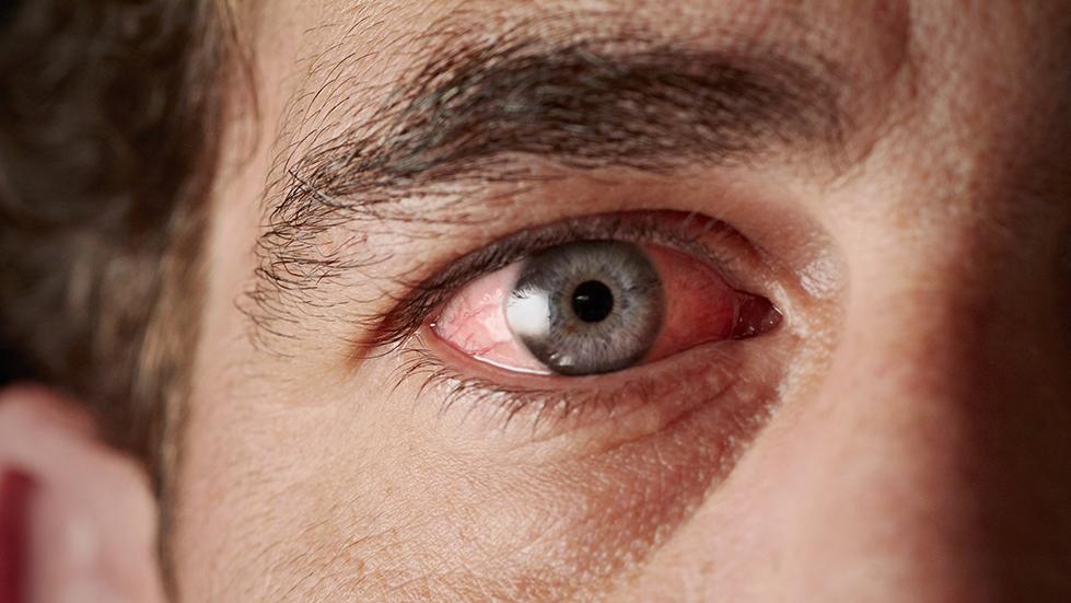¿Cuál es el mejor tratamiento para las quemaduras oculares causadas por el sol?