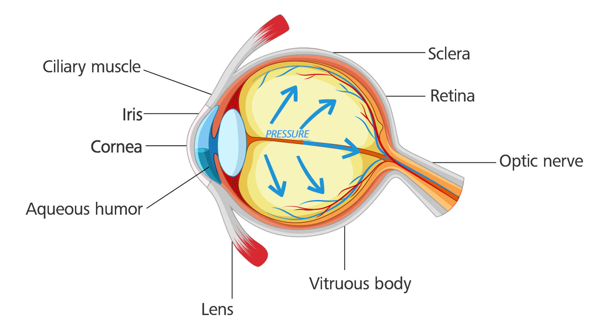 Ojo con glaucoma