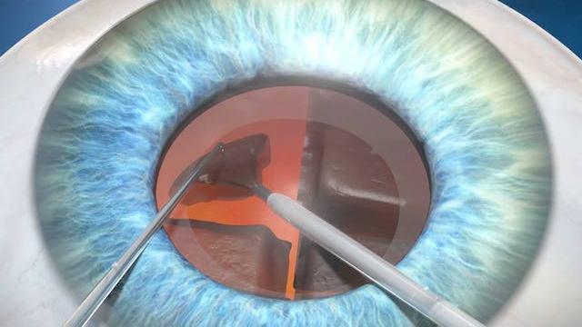 Facoemulsificación
