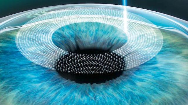 Inmovilización del ojo y creación del flap