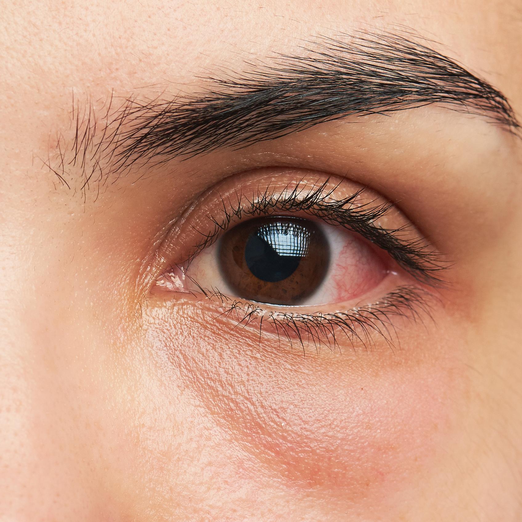 Infección ocular
