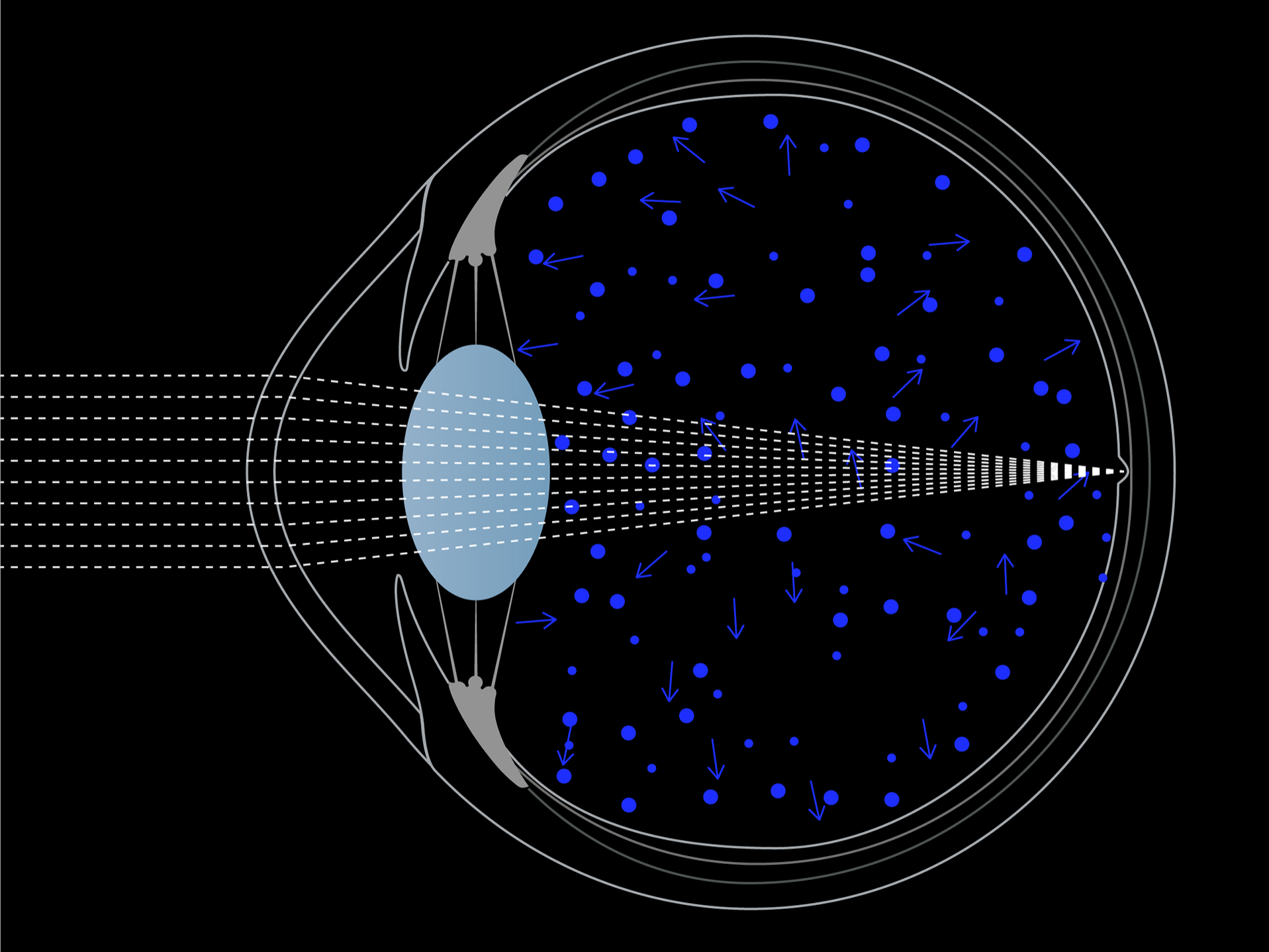 Ilustración de la luz que ingresa al ojo, que muestra cómo la luz azul se dispersa más por el ojo que la luz blanca. 